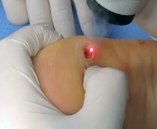 Procedura usuwania brodawek na pięcie za pomocą lasera