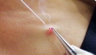 usuwanie brodawczaków na ciele laserem