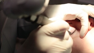 Laserowe usuwanie brodawczaka powieki
